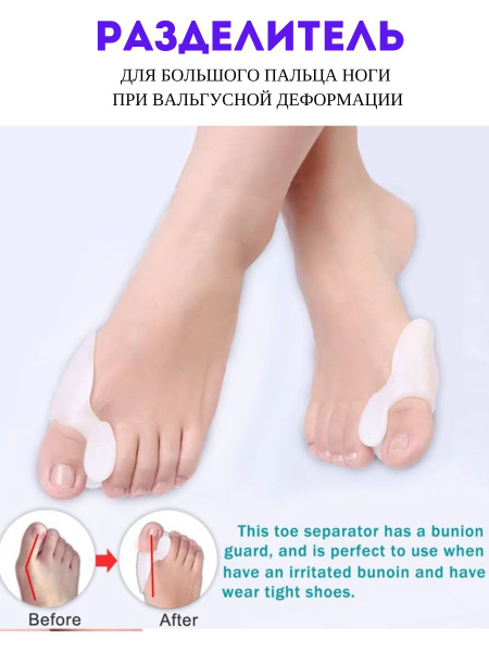 Bunion Corrector: Orthotic Splint for Hallux Valgus