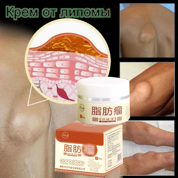Lipoma Removal Cream: Eliminate Fat Deposits &amp; Skin Lumps (30g)