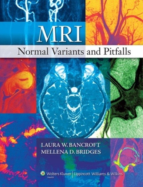MRI Normal Variants and Pitfalls | MRI Normal Variants and Pitfalls