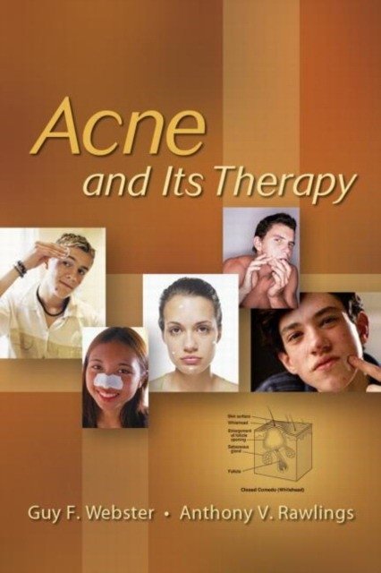 Acne And Its Therapy | Acne and Its Therapy