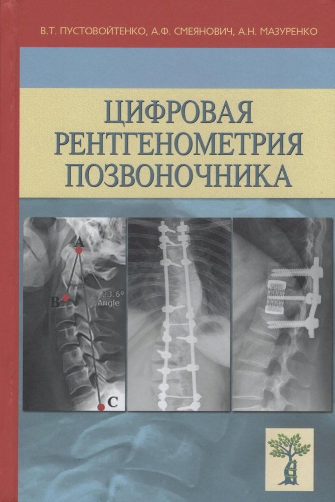 Цифровая рентгенометрия позвоночника | Digital X-ray Measurement of the Spine
