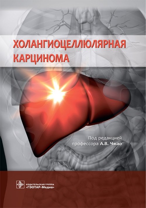 Холангиоцеллюлярная карцинома | Cholangiocarcinoma