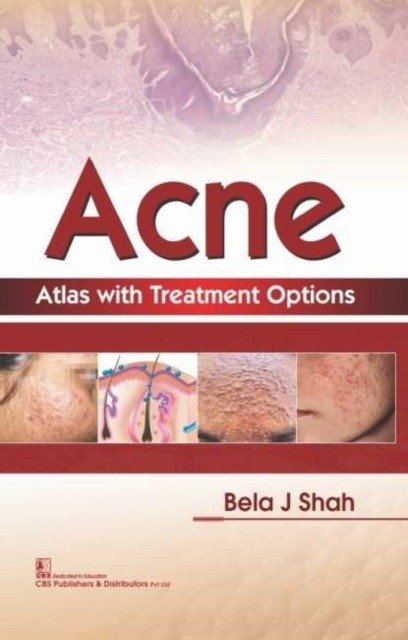 Acne Atlas With Treatment Options (Hb 2018) | Acne Atlas with Treatment Options