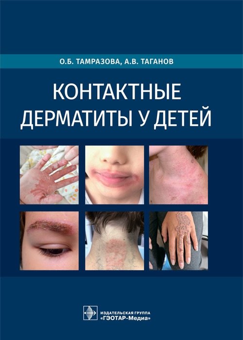 Контактные дерматиты у детей | Contact Dermatitis in Children