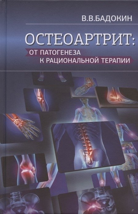 Остеоартрит: от патогенеза к рациональной терапии | Osteoarthritis: From Pathogenesis to Rational Therapy
