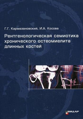 Рентгенологическая семиотика хронического остеомиелита длинных костей | Radiological Semiotics of Chronic Osteomyelitis of Long Bones