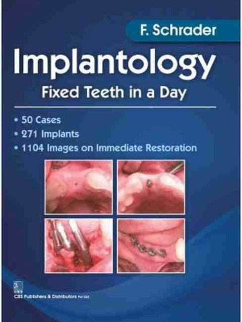 Implantology Fixed Teeth in A Day (PB) | Implantology: Fixed Teeth in a Day