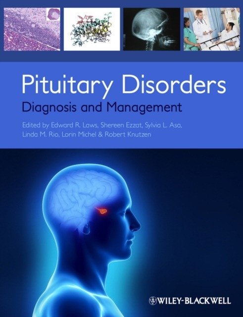 Нарушения гипофиза: диагностика и лечение | Pituitary Disorders: Diagnosis and Management
