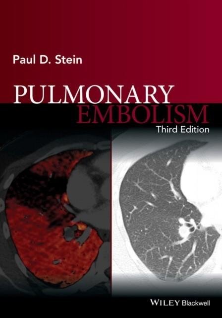 Легочная эмболия | Pulmonary Embolism