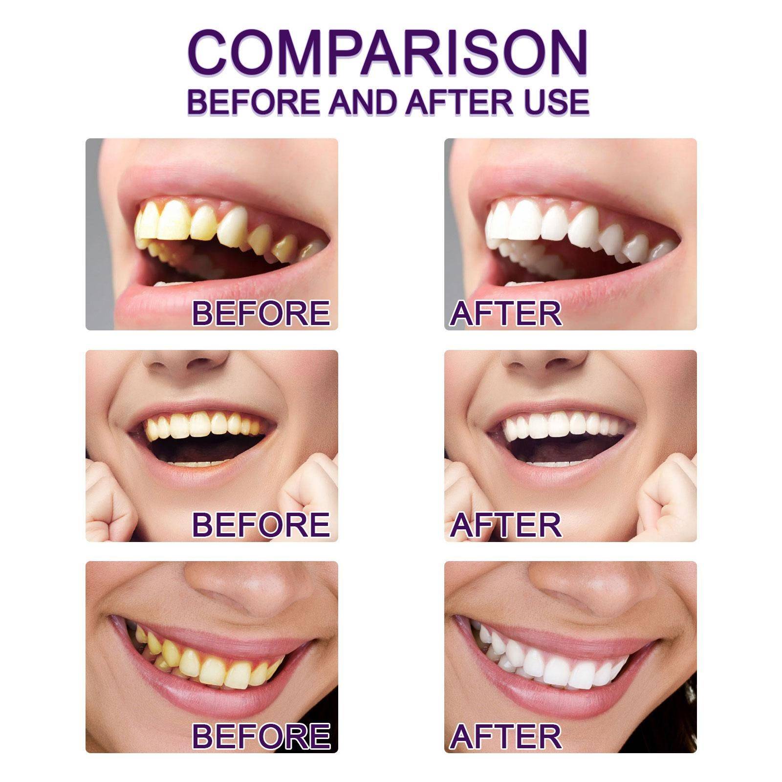 Whitening Pencil for Teeth – Anti‑Pigmentation Gel, 3 ml #11