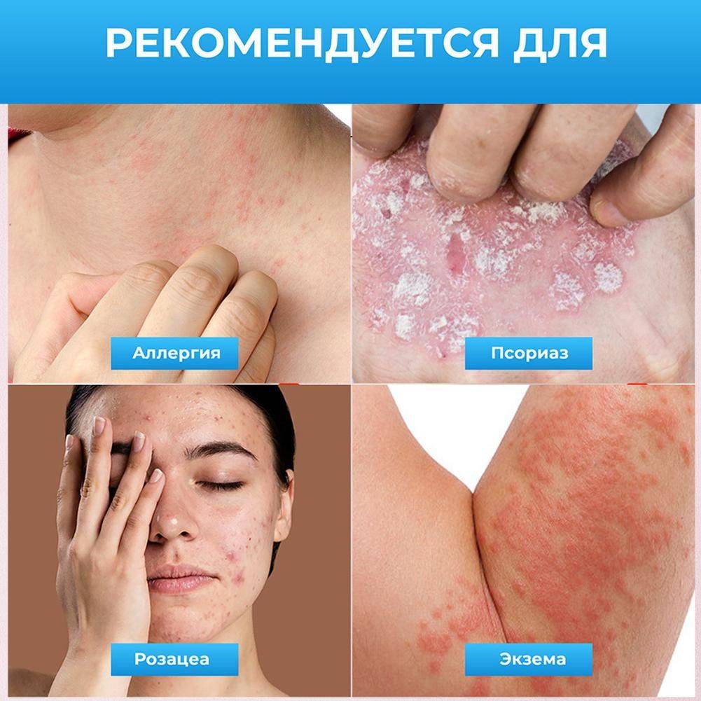 Therapeutic Skin Cream 20 ml – Moisturizing and Soothing for Psoriasis, Dermatitis & Eczema #9