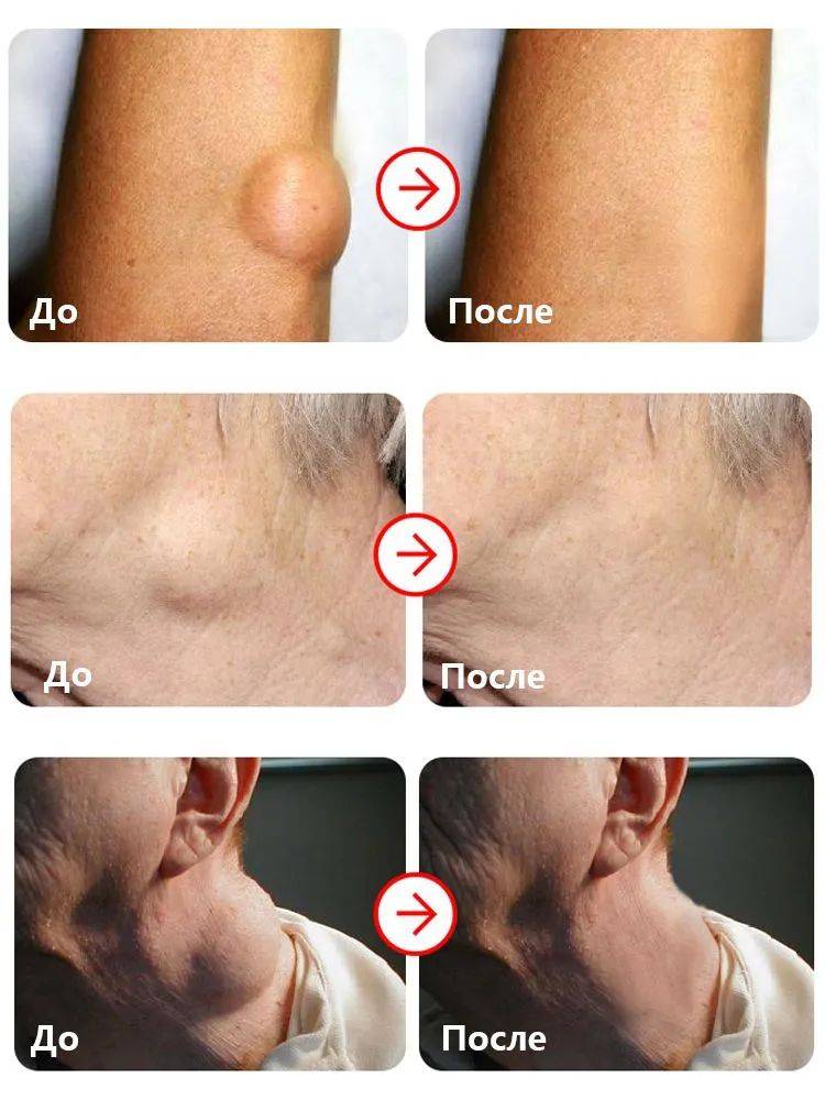 OKQI Lipoma Removal Ointment 30ml #10