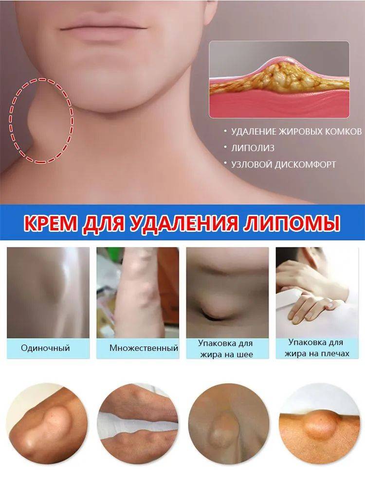 OKQI Lipoma Removal Ointment 30ml #13