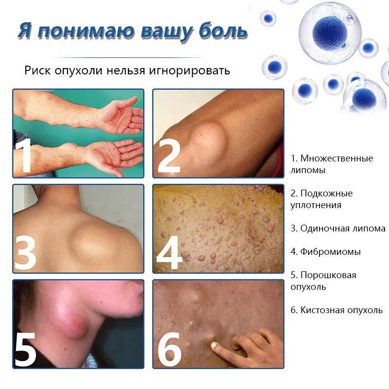 OKQI Lipoma Removal Ointment 30ml #7