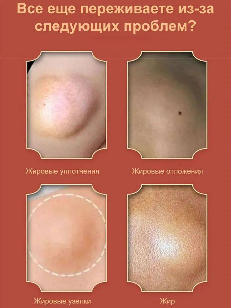 OKQI Lipoma Removal Ointment 30ml #12