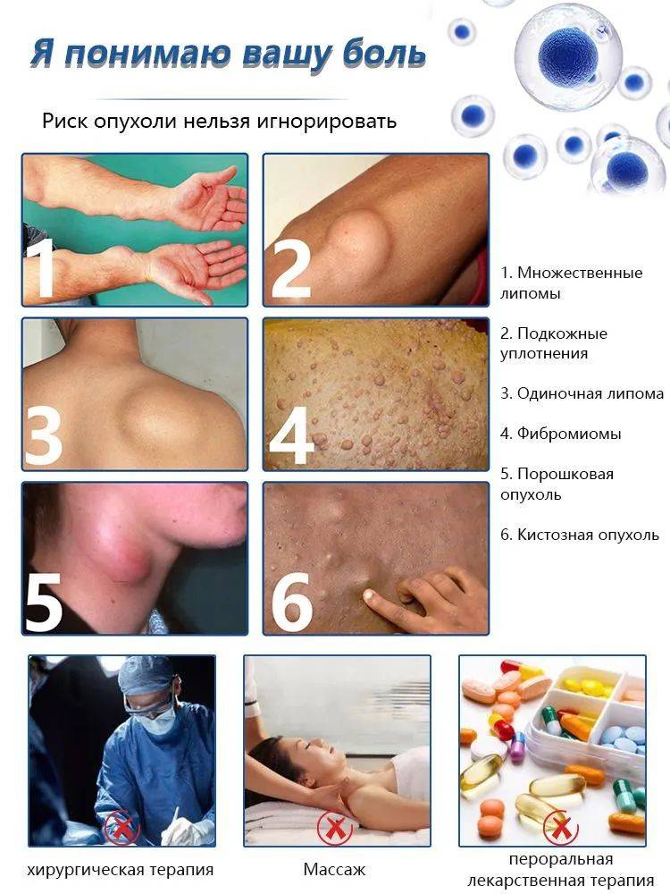 OKQI Lipoma Removal Ointment 30ml #4