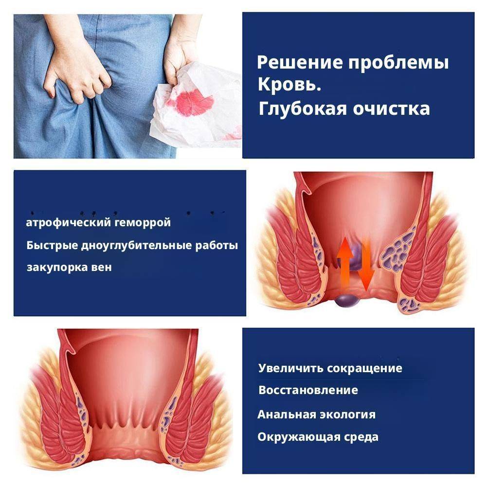 Hemorrhoid Relief Cream 30 g #10