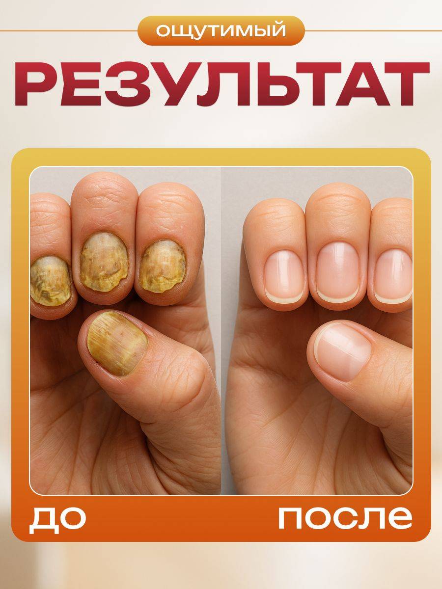 Nail Toke Ointment for Fungal Infections, Strengthen and Restore Nails and Skin, Eliminate Fungal Infections on Toenails #5