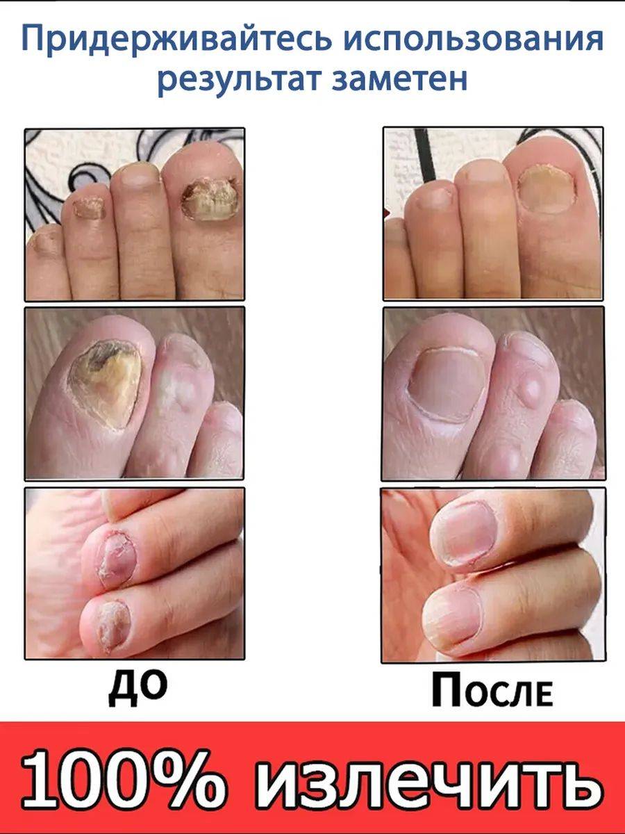 Antifungal Cream for Nail Restoration, Itch Relief, and Health, 20g #8