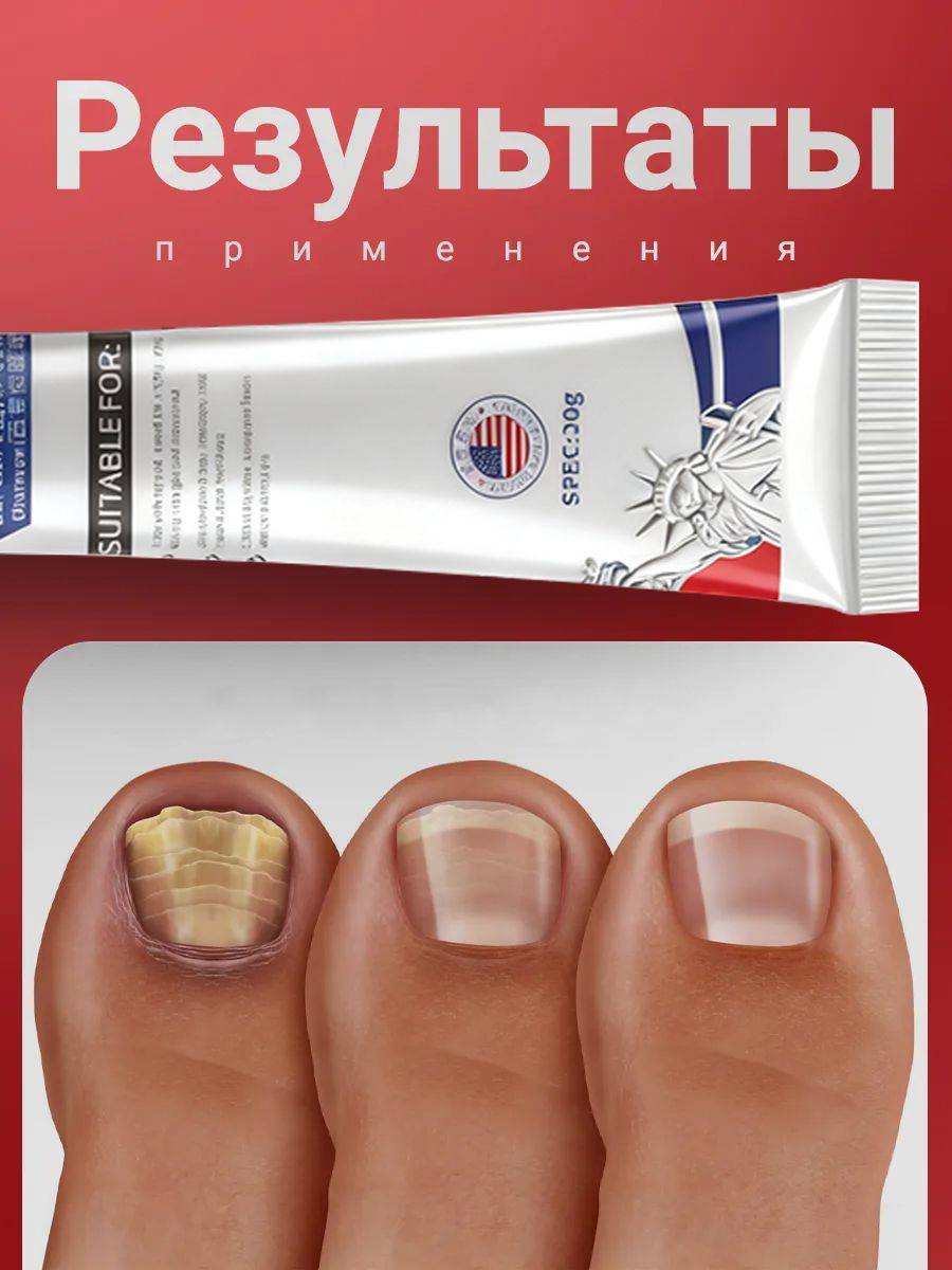 Nail Toke Ointment for Fungal Infections, Strengthen and Restore Nails and Skin, Eliminate Fungal Infections on Toenails #4