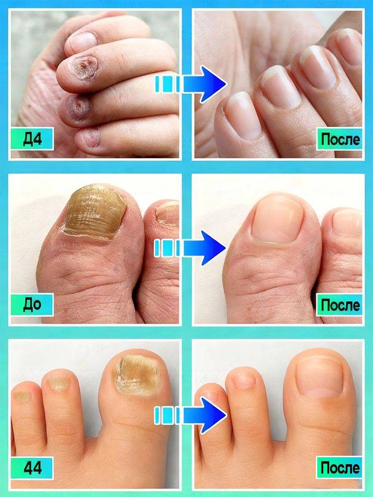 Antifungal Cream for Nail Restoration, Itch Relief, and Health, 20g #9