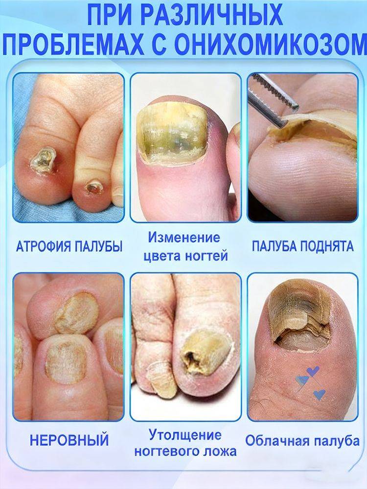 Antifungal Cream for Nail Restoration, Itch Relief, and Health, 20g #5