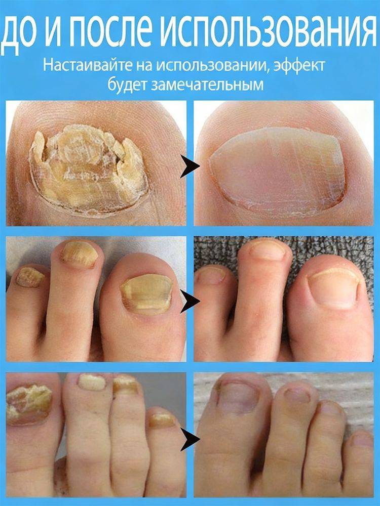 Antifungal Cream for Nail Restoration, Itch Relief, and Health, 20g #7