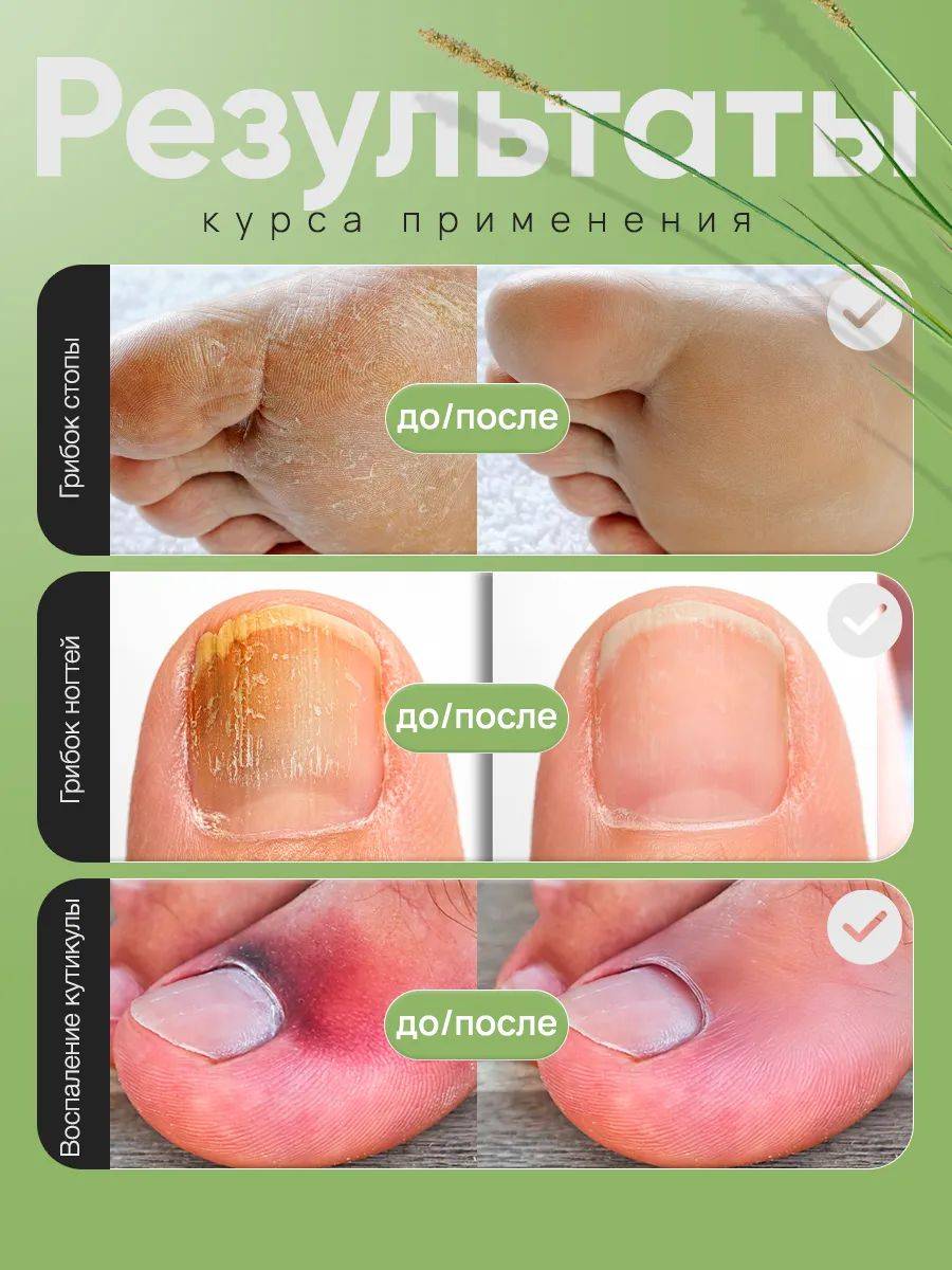 Nail Toke Ointment for Fungal Infections, Strengthen and Restore Nails and Skin, Eliminate Fungal Infections on Toenails #3
