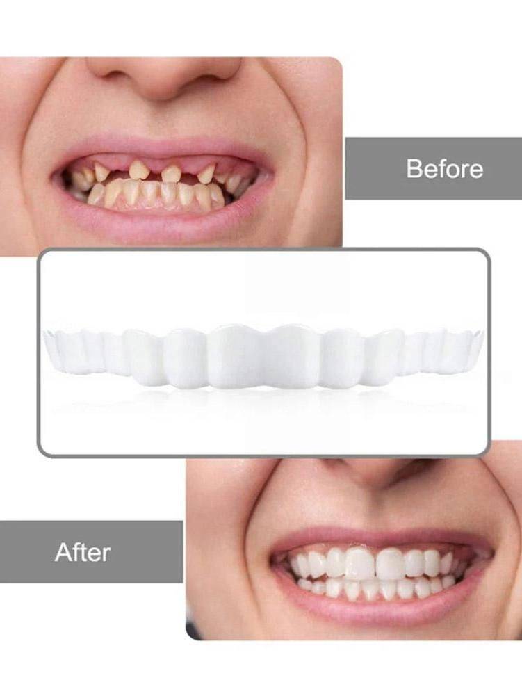 Temporary Decorative Braces Set – Upper and Lower Teeth #19