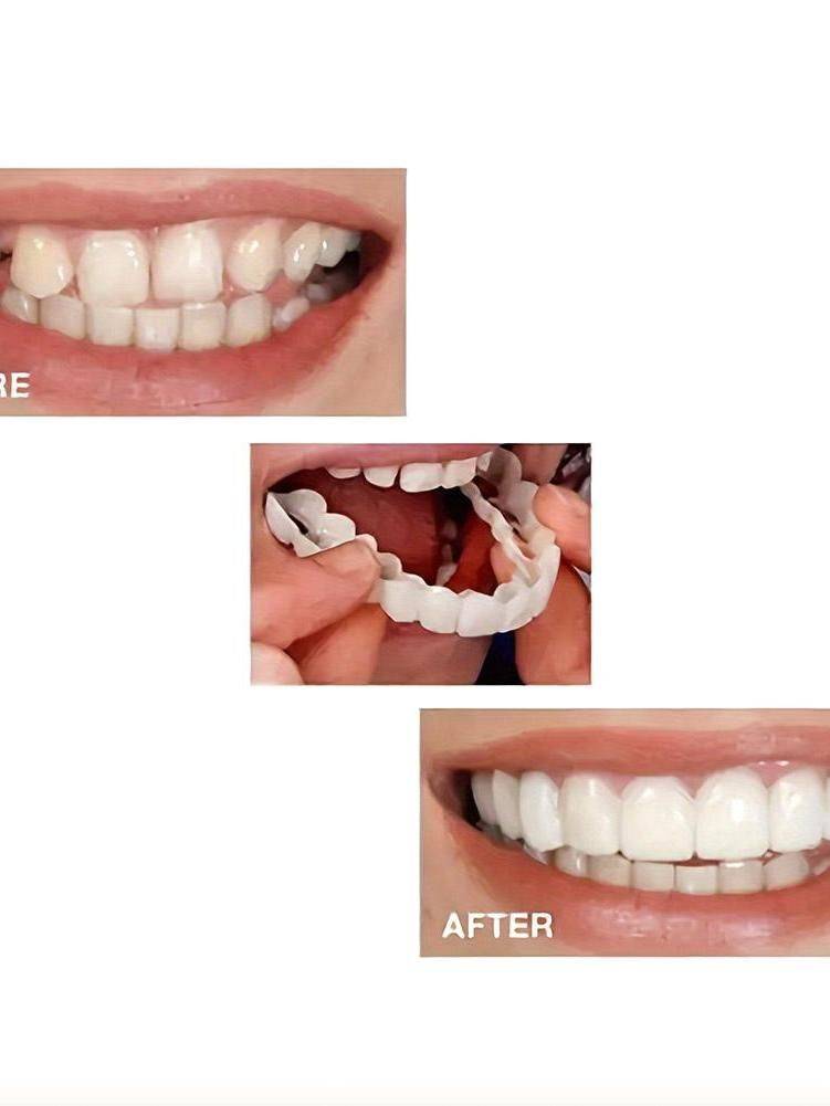 Temporary Decorative Braces Set – Upper and Lower Teeth #4