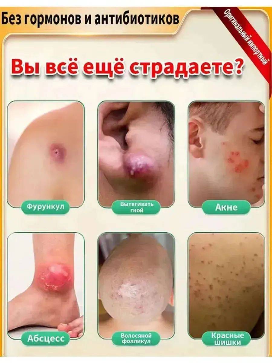 Vishnevsky Ointment for Fungal Infections, Acne, and Abscesses 20g #6