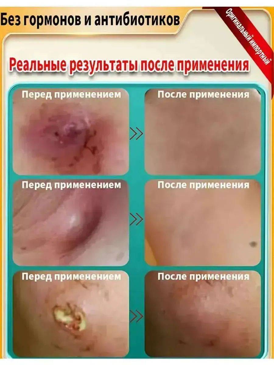 Vishnevsky Ointment for Fungal Infections, Acne, and Abscesses 20g #4