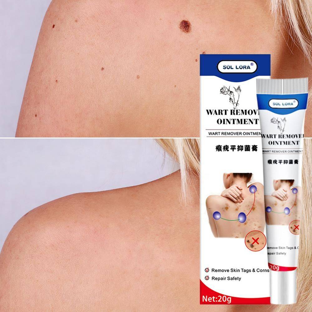 WartRemoval Cream 20g Pain-Free Solution for Sensitive Skin #7