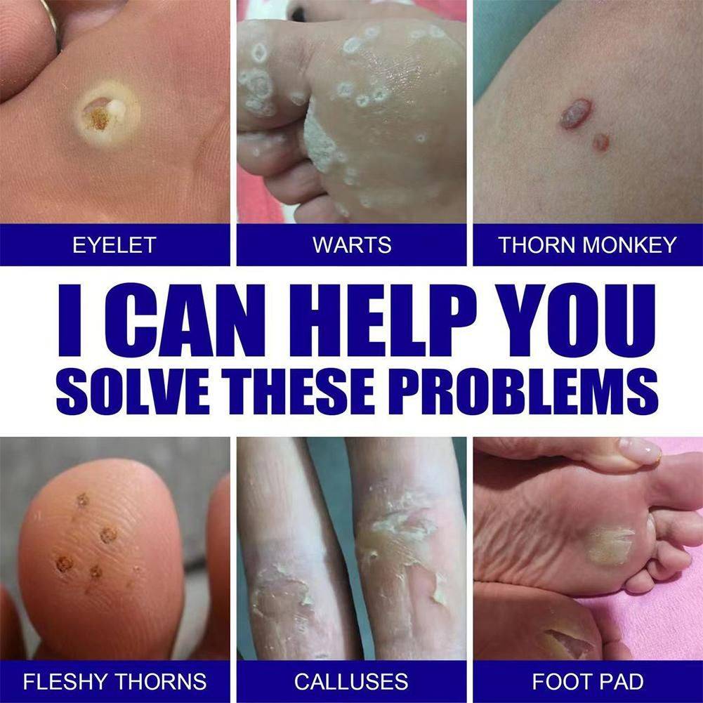 WartRemoval Cream 20g Pain-Free Solution for Sensitive Skin #11