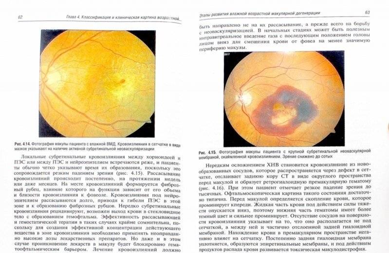 Возрастная макулярная дегенерация фото книги 2