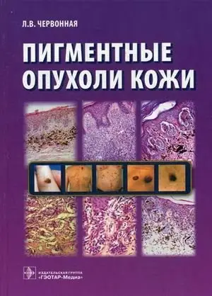 Пигментные опухоли кожи фото книги