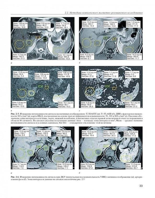 МРТ-диагностика очаговых заболеваний печени фото книги 7