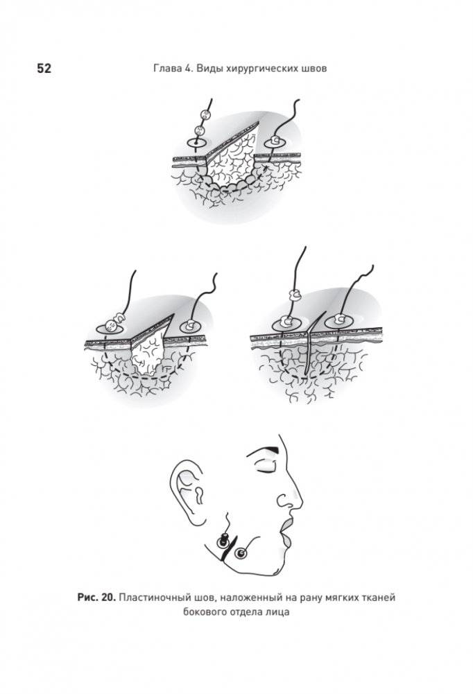 Хирургический шов. 3-е издание, обновленное фото книги 8