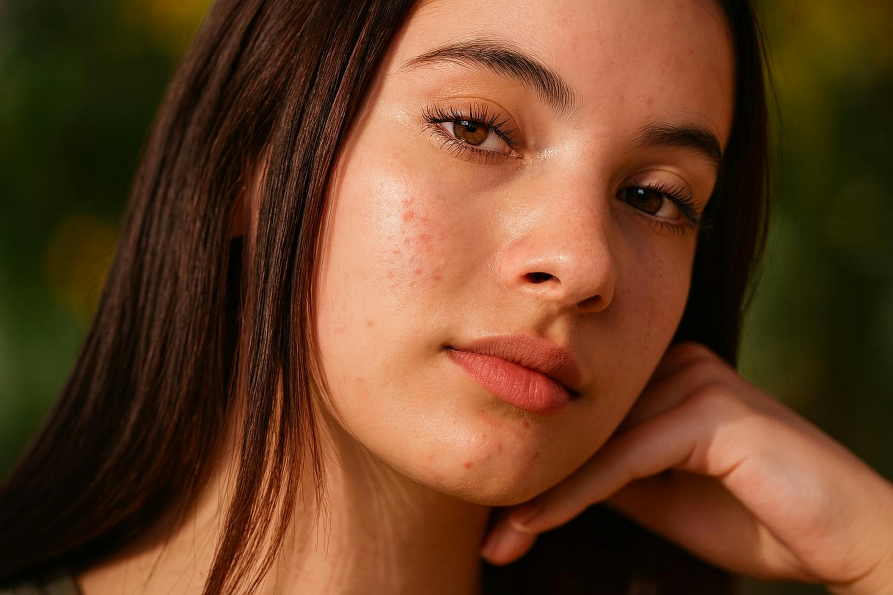 AI Acne Diagnosis in Utah: How Artificial Intelligence Is Changing Skin Care