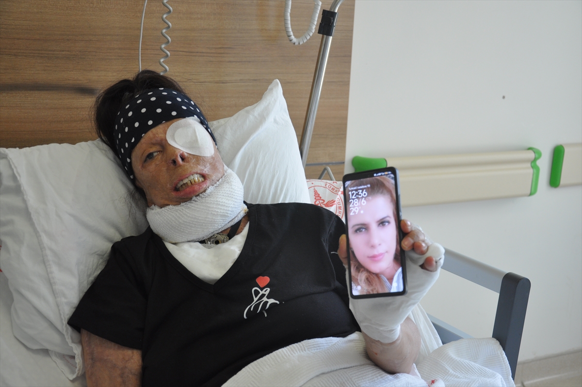 Eskişehir'de Kezzap Saldırısının Ardından Umut Veren Tedavi Süreci