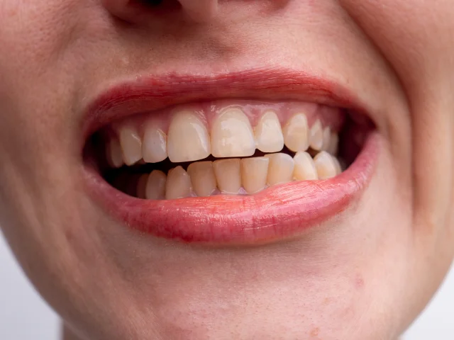 Bruksizm: Diş Gıcırdatmanın Görünmeyen Tehlikesi