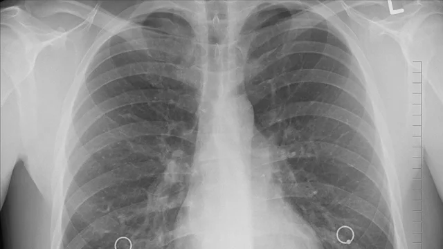 Uzmanlar Uyarıyor: Akciğer Kanserinde Çevresel Faktörlerin E...