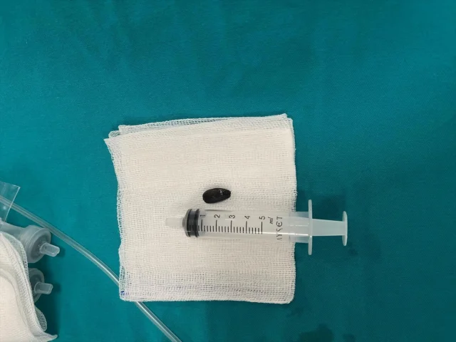 Minik Bebeğin Hayatı Batman'da Kurtarıldı: Akciğerden Çekird...