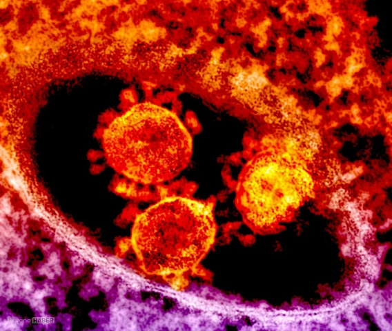 Aşısı olmayan Ebola türü Afrika'da yayılıyor: 130'dan fazla ölü var