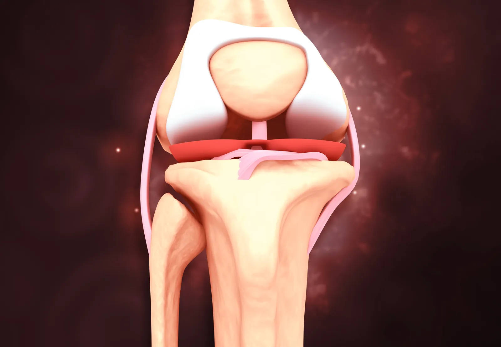 Medizinische 3D-Illustration eines menschlichen Kniegelenks mit einer deutlichen Verletzung oder Abnutzung am Meniskus.